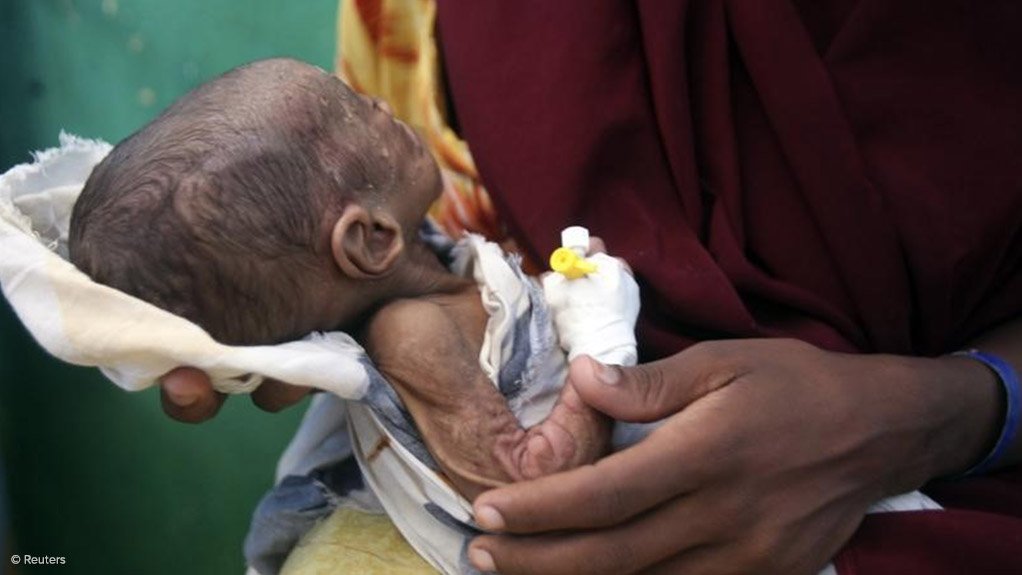 Malnourished Somalian Child 